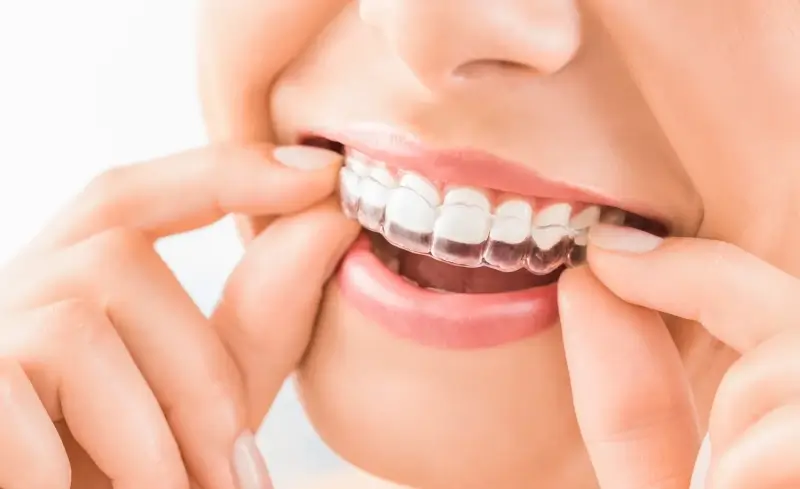 Invisalign dla kogo?